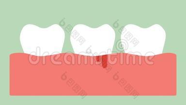 牙龈炎或牙龈疾病伴有出血，牙周病前牙龈发炎